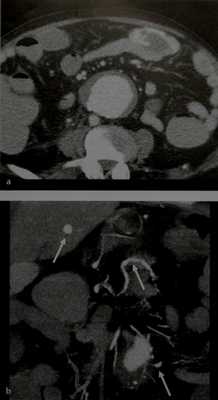 Снимки МРТ и КТ. Желудочно кишечное кровотечение