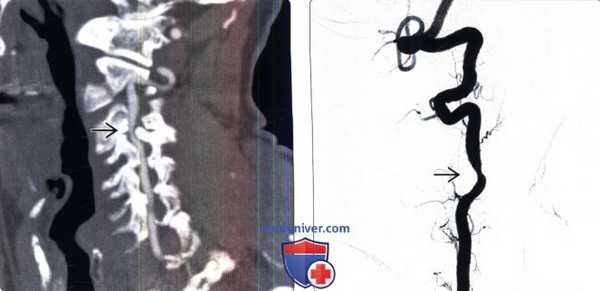 КТ, ангиограмма при синдроме лучника