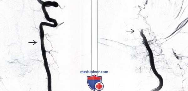 КТ, ангиограмма при синдроме лучника