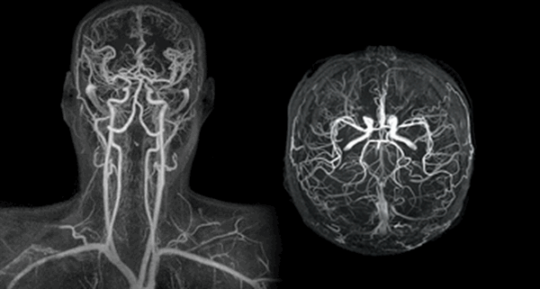 МР-ангиография сосудов головы и шеи