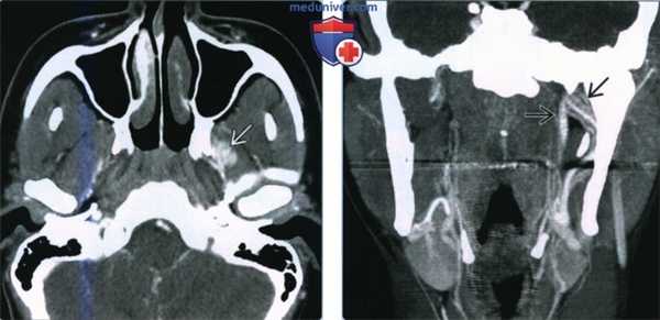 Асимметрия крыловидного венозного сплетения - лучевая диагностика