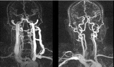 КТ сосудов шеи фото