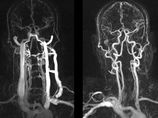 МРТ сосудов шеи