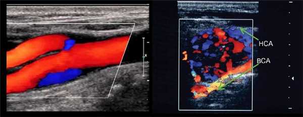 Расшифровка снимков МРТ сосудов шеи