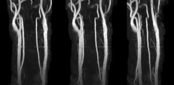 МРА сосудов шеи