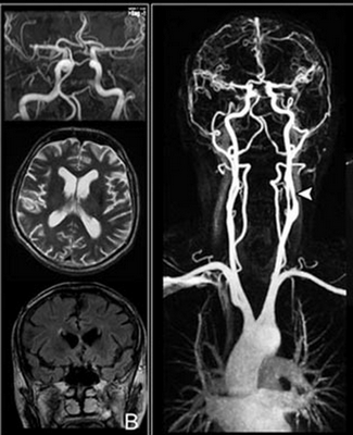 МРТ сосудов головы и вещества головного мозга
