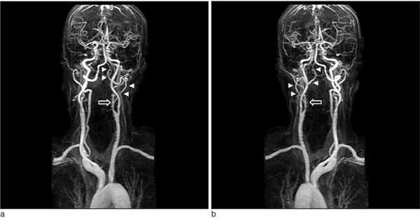 МРТ или УЗИ сосудов шеи, что лучше