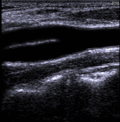 УЗИ сонной артерии