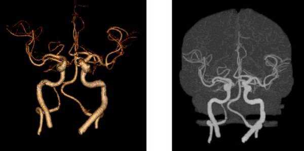3D-изображения компьютерной мультиспиральной томографии Виллизиева круга. Его контуры можно увидеть на томограмме в центре, шея внизу, основные артерии белого цвета.