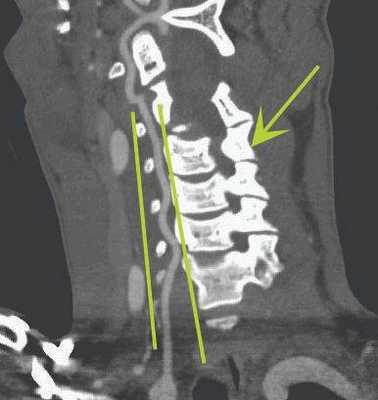 КТ-ангиограмма кровеносных сосудов в области шеи. Позвоночная артерия находится между вертикальными линиями. Стрелка указывает на позвоночник