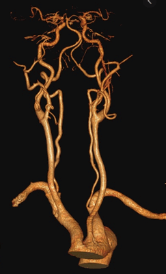 КТ сосудов шеи и головного мозга в 3D