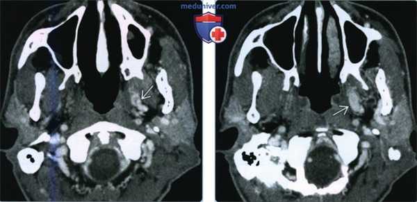 Асимметрия крыловидного венозного сплетения - лучевая диагностика