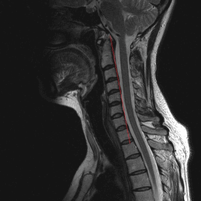 МРТ шейного отдела позвоночника