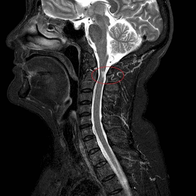 МРТ шеи: перелом зубовидного отростка с невральной компрессией
