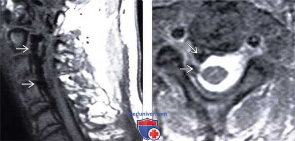 КТ, МРТ, ангиограмма при травматической артериовенозной фистуле позвоночника