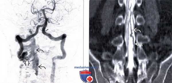 КТ, МРТ, ангиограмма при травматической артериовенозной фистуле позвоночника