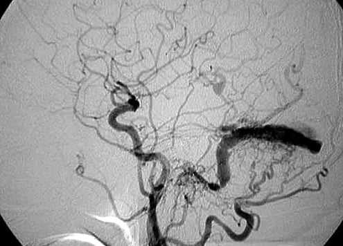 Снимки МРТ и КТ. Дуральная артериовенозная фистула