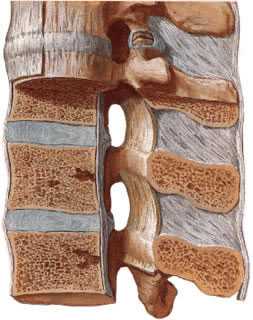 При спондилите тел позвонков будут изменена их костная плотность в плоть до полного разрушения.