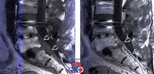 КТ, МРТ бруцеллезного спондилита