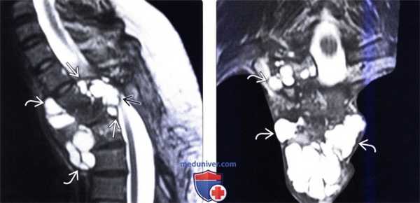 КТ, МРТ эхинококкоза позвоночника
