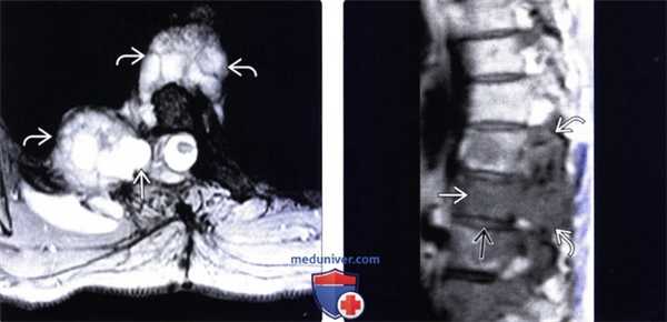 КТ, МРТ эхинококкоза позвоночника