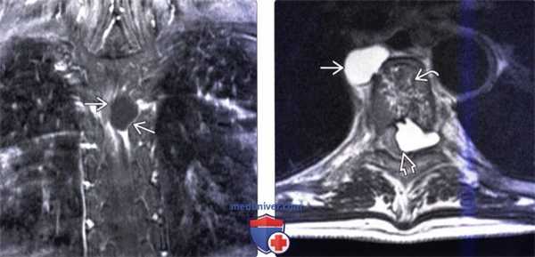 КТ, МРТ эхинококкоза позвоночника