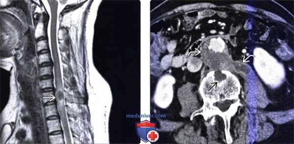 КТ, МРТ при оппортунистических инфекциях позвоночника