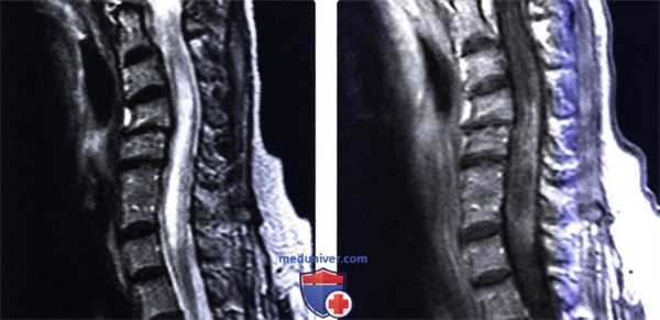 МРТ при оппортунистических инфекциях позвоночника