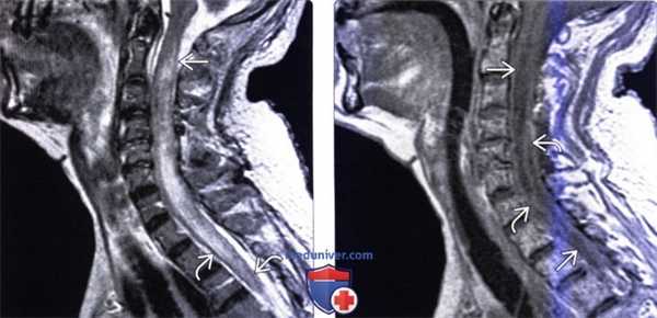 МРТ при оппортунистических инфекциях позвоночника