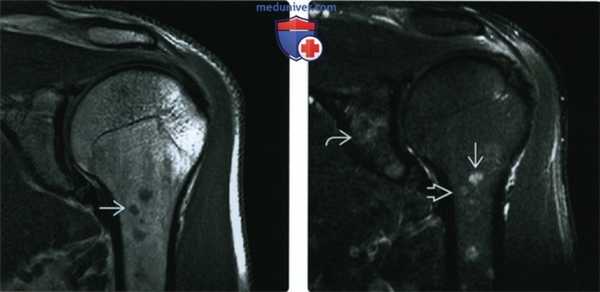 Рентгенограмма, КТ, МРТ костей при саркоидозе