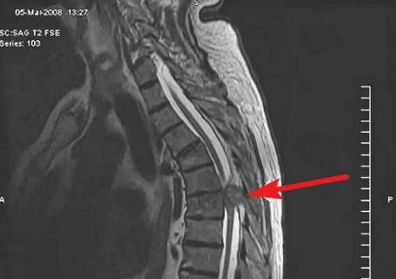 Изображения позвоночника МРТ с миелографией