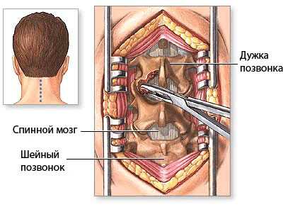 Операция гемиламинэктомия при стенозе позвоночного канала со сдавлением спинного мозга на уровне шейного отдела позвоночника с гипертрофией задней продольной и жёлтой связки.