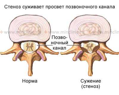 Стеноз (сужение) просвета позвоночного канала со сдавлением спинного мозга с гипертрофией задней продольной и жёлтой связки.