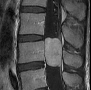 эпендимома