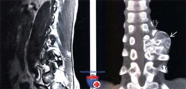 КТ, МРТ остеохондромы позвоночника