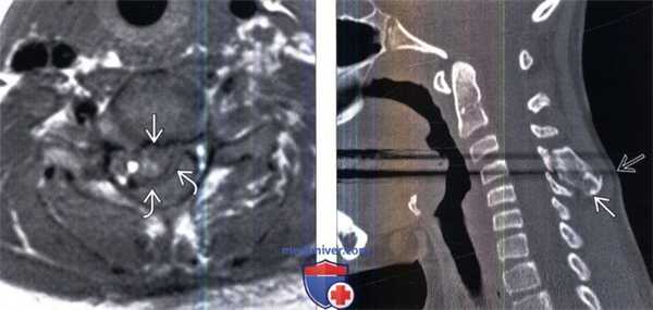 КТ, МРТ остеохондромы позвоночника
