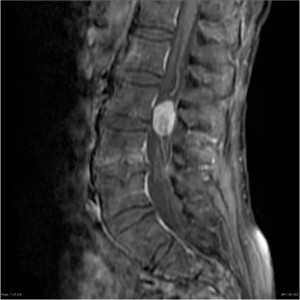 ганглионеврома