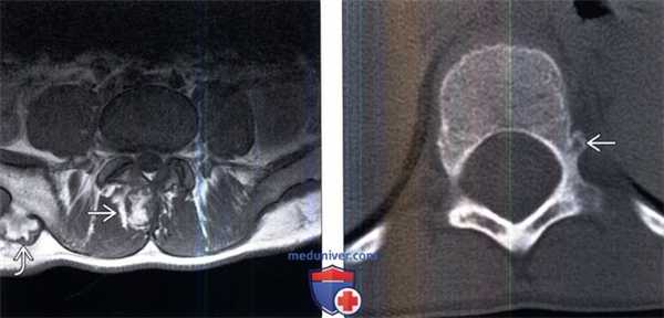 КТ, МРТ остеохондромы позвоночника