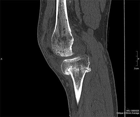 КТ коленного сустава