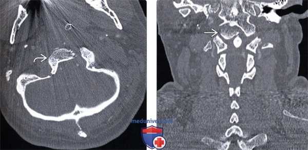 КТ, МРТ перелома мыщелка затылочной кости