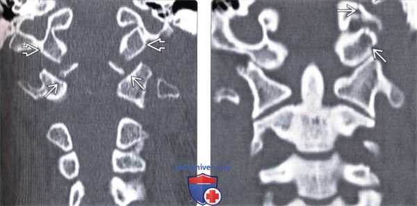КТ, МРТ перелома мыщелка затылочной кости