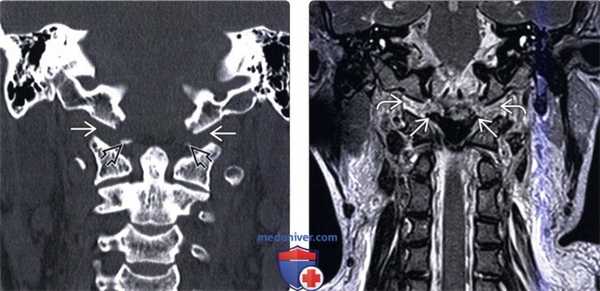 Рентгенограмма, КТ атланто-затылочной дислокации