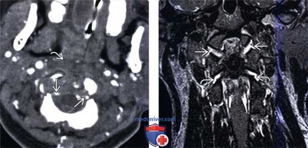 КТ, МРТ атланто-затылочной дислокации