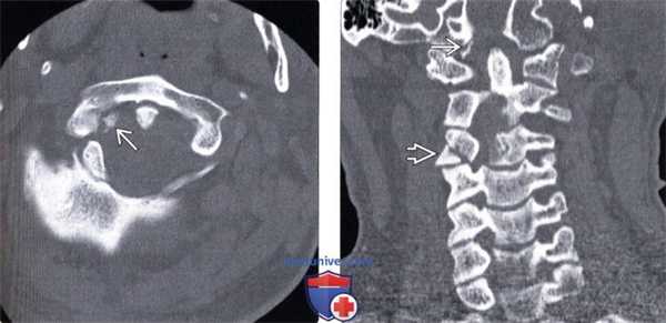 КТ, МРТ перелома мыщелка затылочной кости