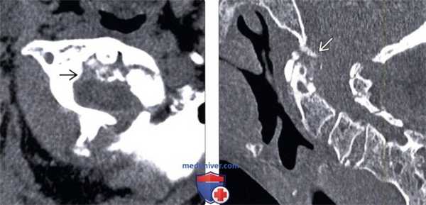 КТ, МРТ перизубовидной псевдоопухоли