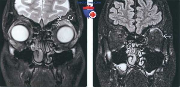 Лучевая диагностика инвазивной псевдоопухоли