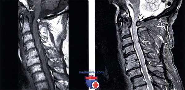 КТ, МРТ перизубовидной псевдоопухоли