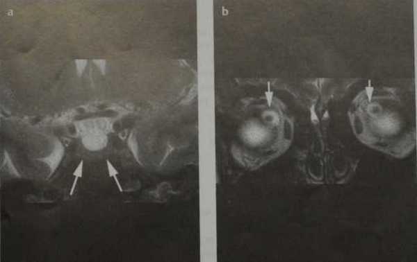 Снимки МРТ и КТ. Псевдоопухоль головного мозга