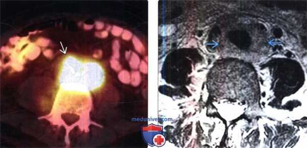 Лучевая диагностика ретроперитонеальной и мезентериальной лимфомы