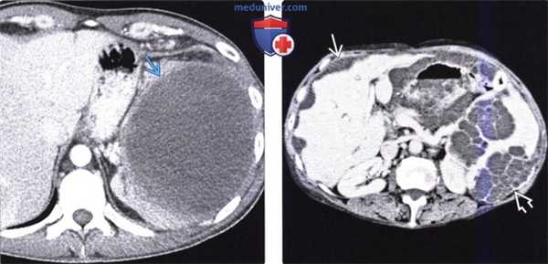 КТ, МРТ, УЗИ, ПЭТ при метастазе в селезенку и лимфоме селезенки